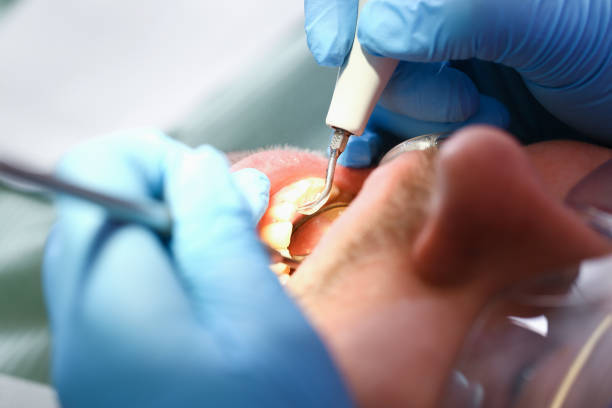 Best Emergency Treatment for Dental Infections or Abscesses in Wilton Manors, FL